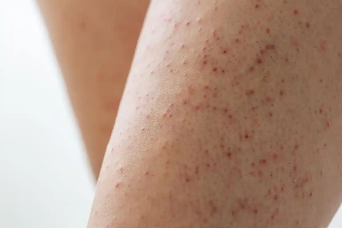 毛周角化症(keratosis pilaris)是一种常见的干燥皮肤病,由毛囊中角