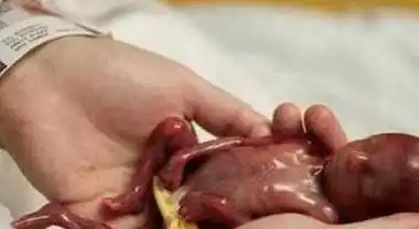 但效果不佳,只能依赖药物来保住这个未满五个月就面临生存挑战的胎儿