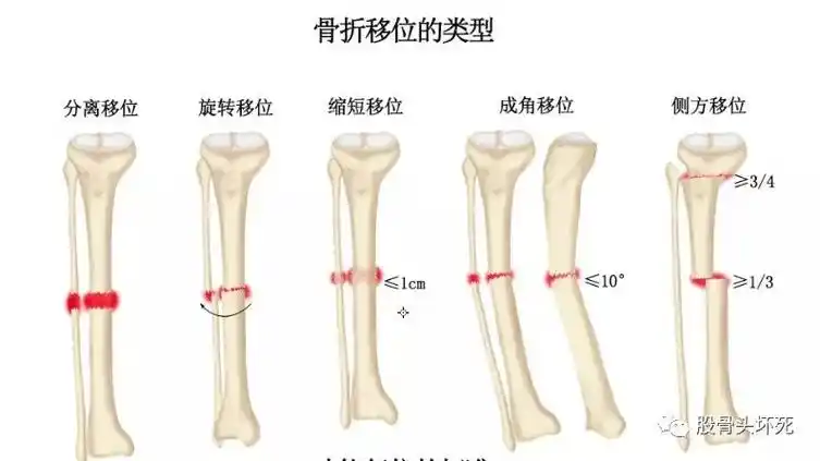 骨折不超过1cm;儿童若无骨骺损伤,下肢缩短在2cm以内,在生长发育过程