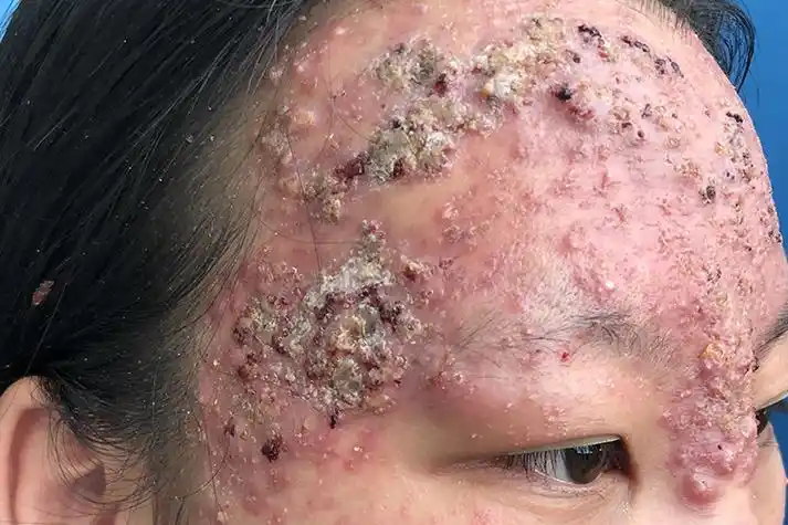 聚合性痤疮症状图