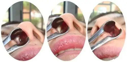 孩子患上鼻息肉怎么办呢?北斗星儿童医院来帮您!_武汉北斗星儿童医院