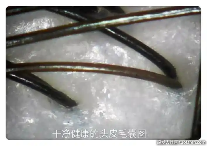 干净健康的头皮毛囊图