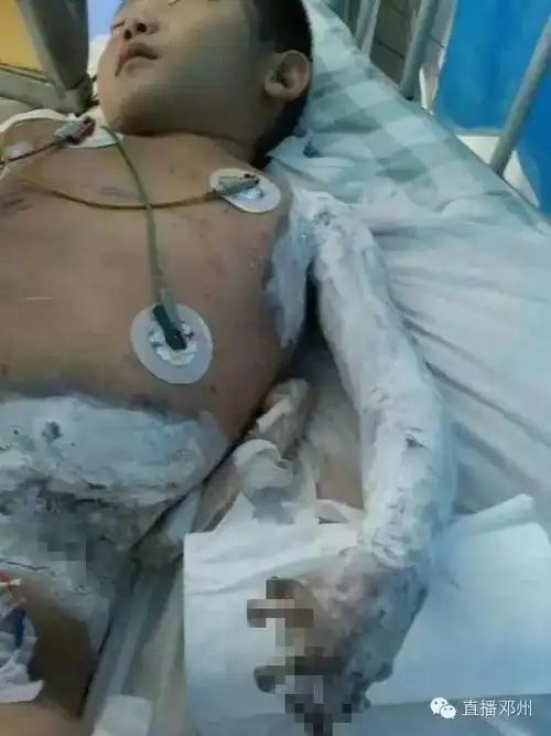 救助邓州六岁严重电击伤儿迫在眉睫!求爱心接力