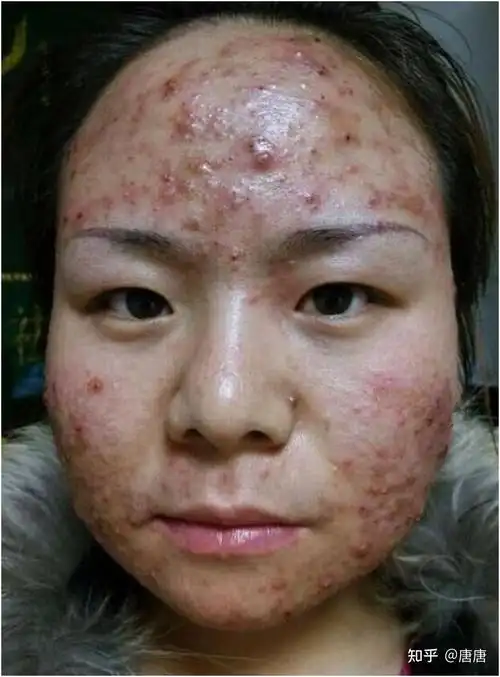 容易破坏皮肤阻组织,伤害到肌肤,因此挤压痘痘并不是根治痘痘的方法