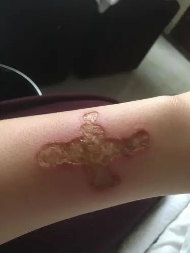 某种原因导致心理特别痛苦,喝多了之后烫了这些烟疤,醒来之后特别后悔