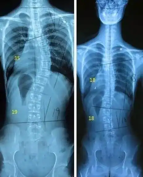 青少年脊柱侧弯自我筛查——湘潭市中医医院康复医学科爱心义诊活动