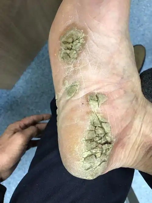 手足皮肤突然增厚,角化,要小心可能是体内有癌