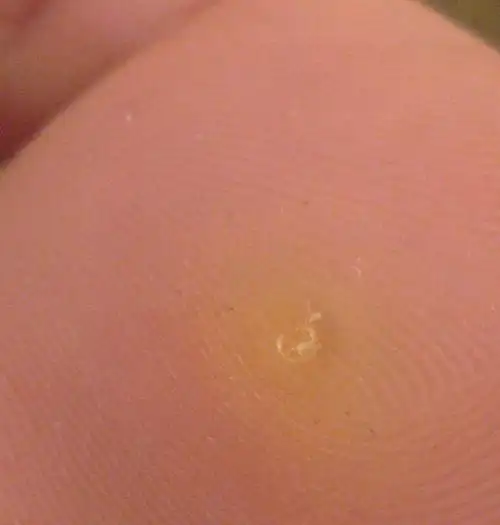 脚底长了个包,不知道是什么