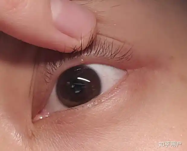 好害怕,觉得眼结石 ,求推荐眼药水?