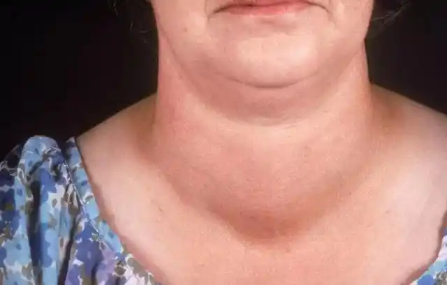 如果出现早期甲状腺癌症状一定不能拖,要及时就诊治疗