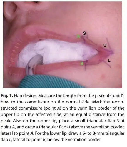 第394期-巨口畸形的治疗