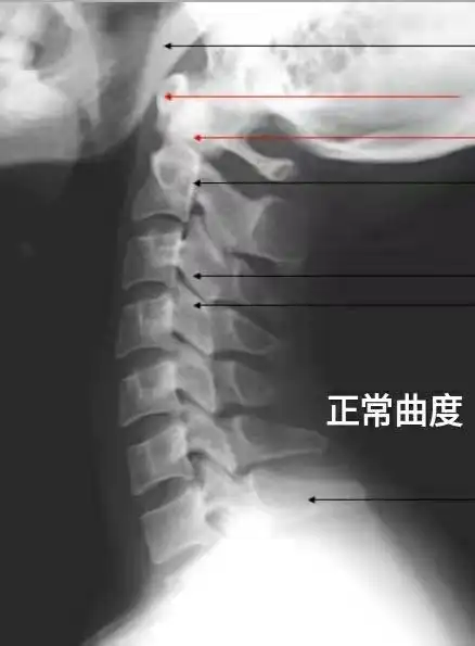 医生说这个就是正常的颈椎侧位dr片了,叫我比较.