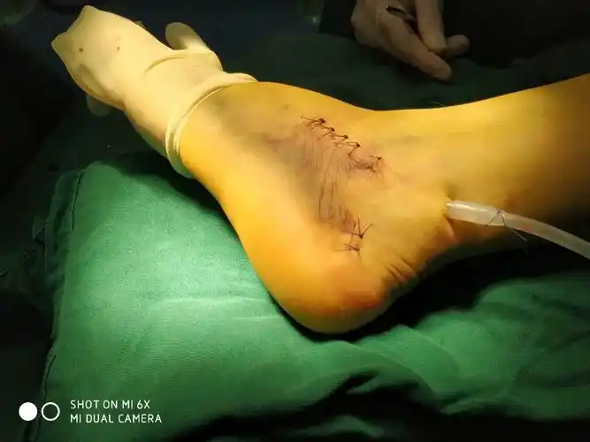 跗骨窦入路有限切开治疗跟骨骨折