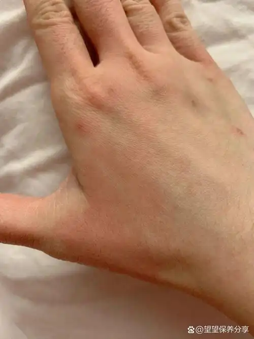 手背泛红刺痛