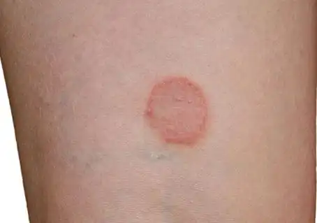 皮肤上出现斑块图片