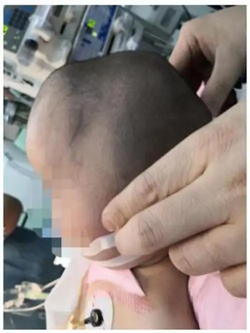 狭颅症不仅仅造成头颅外观畸形及面容异常,部分患儿还会因颅腔狭小而