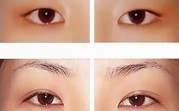 大同322医院双眼皮图片 双眼皮整形前后对比图