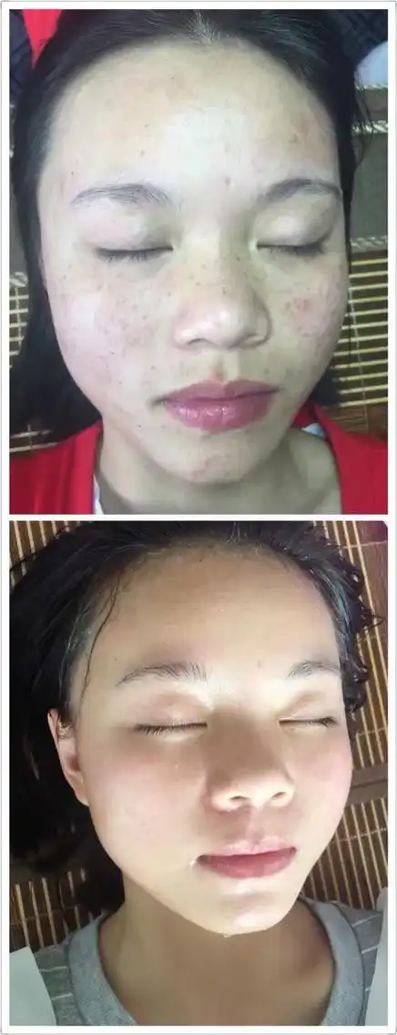 斑前后对比图