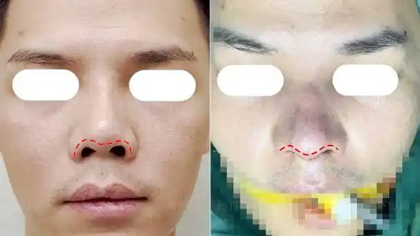 鼻翼缘退缩(露鼻孔)修复