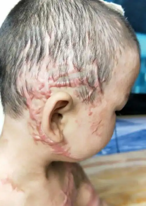 首先,只要伤到了真皮层甚至更深就一定会留疤,手术只能改善,疤痕一定