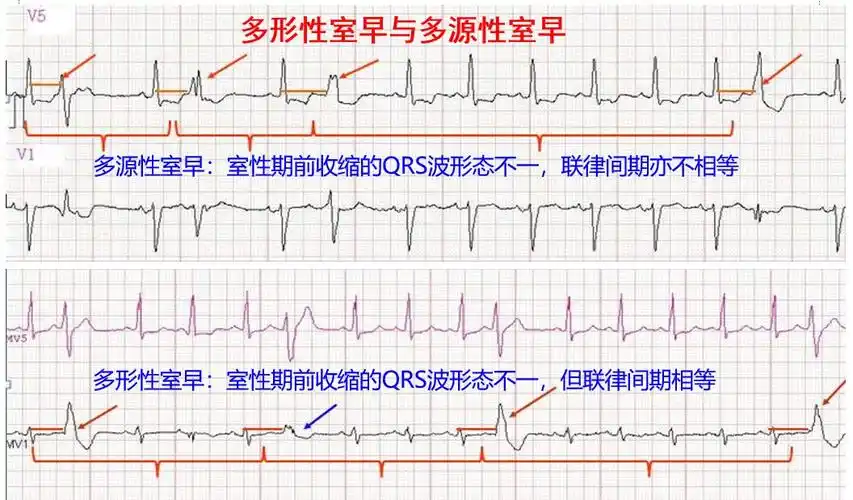 像心内科医生一样分析室性早搏_病理性