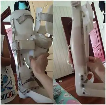 儿童罗圈腿矫正