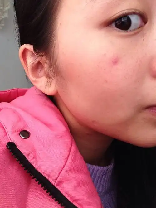 问:半年前颧骨处出现了一个红点,直径约5毫米左右,没有变大和颜色加深