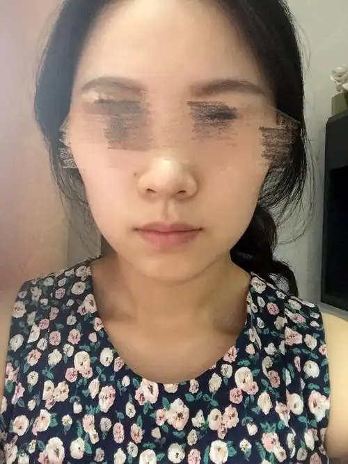 我是没下巴星人,而且是下巴往内凹陷的奇葩星人