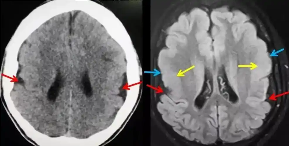 高尚病例:巨脑回畸形