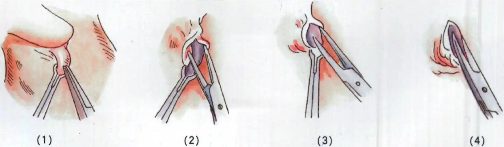 (一)输精管结扎术输精管结扎术是 一种安全,简便,可靠的男性