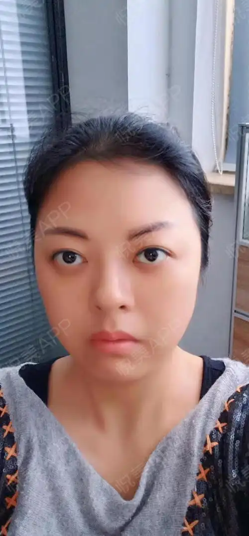 泪沟术后125天_激光去眼袋术后125天_面部填充术后125天_去眼袋术后