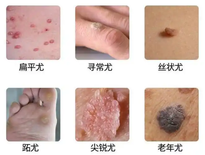 土方治扁平疣疙瘩1周就没了