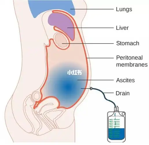 多年腹腔积液如何治疗,还能好吗?