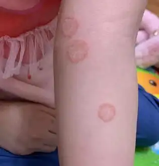 【讨论】猫藓传染给人怎么办