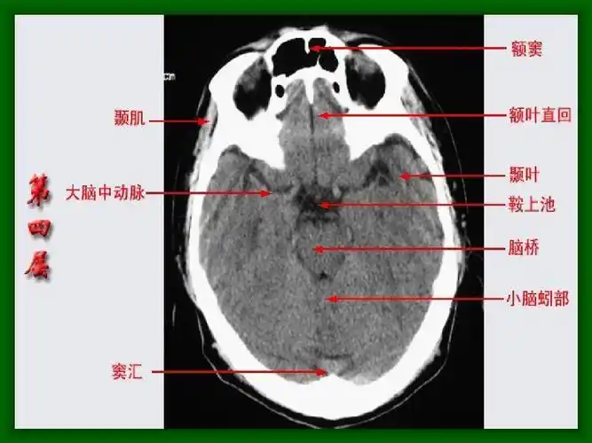 头颅ct解剖图片