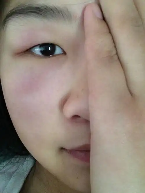 孕妇单侧眼睛浮肿怎么回事?