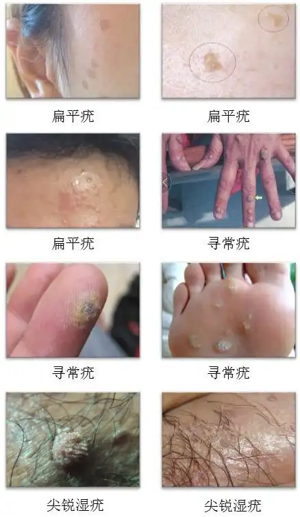 瘊子怎么治疗治疗瘊子建议采取外科手术方式