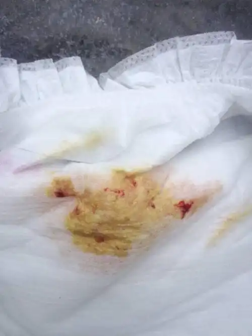 宝宝45天了,今天发现大便有血?求各位支招,(急急!) 下附图片