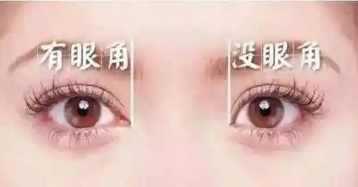 什么是开眼角1个开内眼角9个留疤