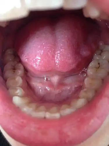 我的牙齿里面有些黑黑的,我刷了很多次牙,但还是这个样子,我很注意