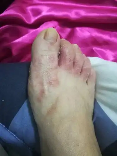 我这脚是怎么回事,湿疹吗