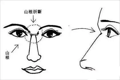 鼻子山根处于鼻根部,两眼之间,是鼻子的起点.