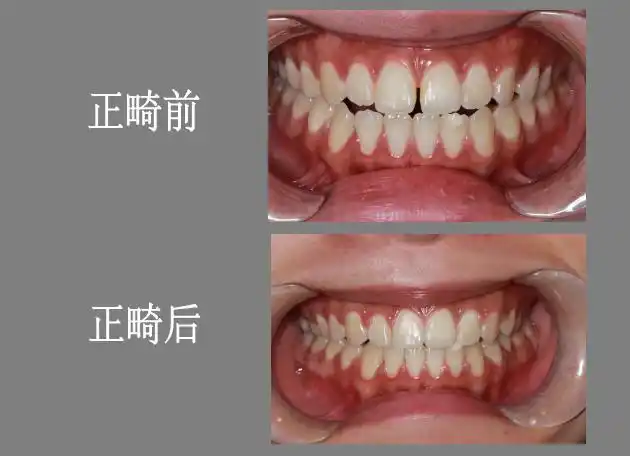 吕杰 关于牙齿稀疏的修复办法4,对口腔健康有害:稀疏的牙齿常常 咬合