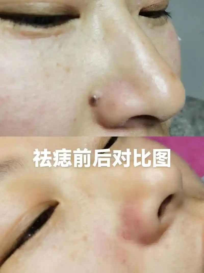 英英美妆工作室祛痣前后对比图