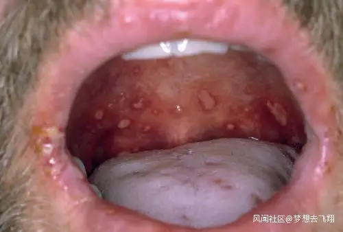 手足口病是怎样的疾病