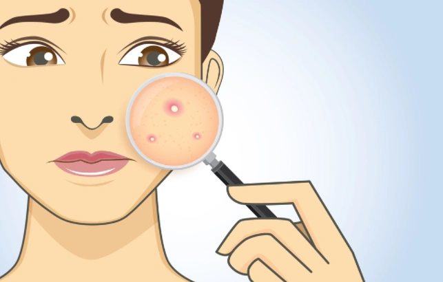 痤疮也要有疫苗了青春痘要成为历史