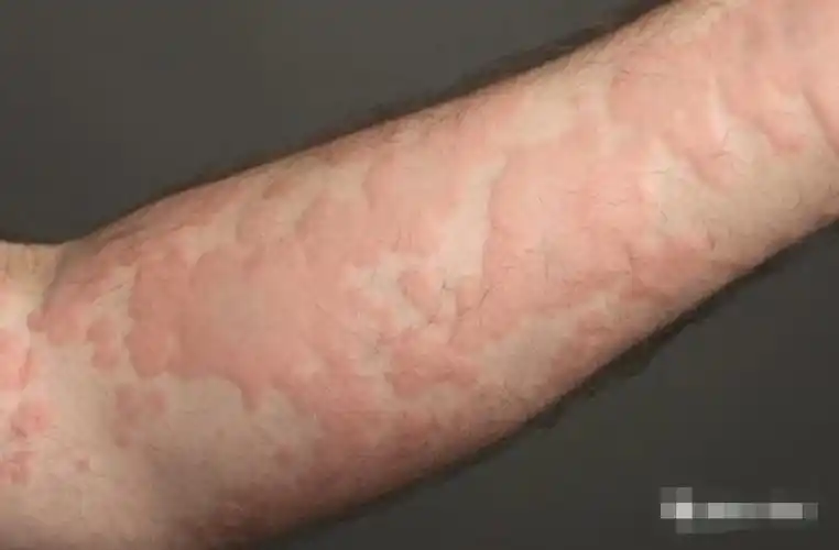 痒到不行,抓了更严重的荨麻疹,该怎么办