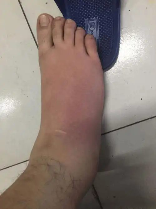 被痛风折磨疯了中西医都没用直到病友告诉我这个方子