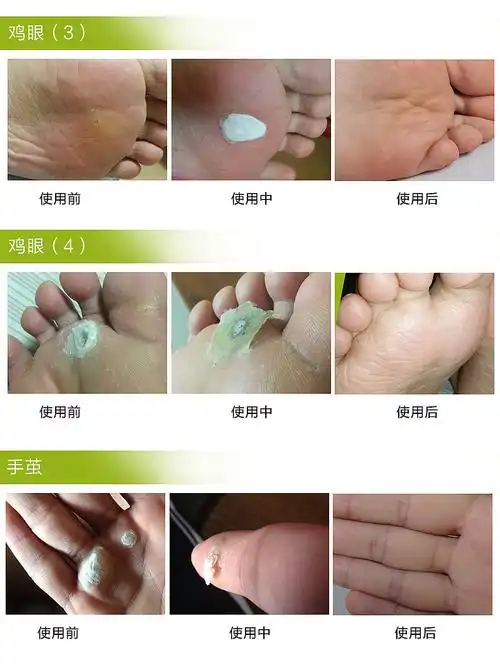 玛卡金恩生物膜去鸡眼膏除脚趾老茧贴祛瘊子跖疣液脚茧净脚垫脚底