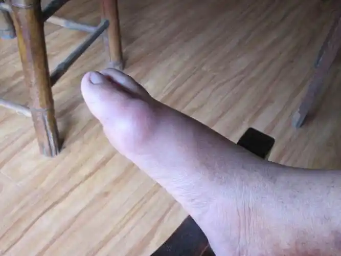 为何痛风发病时我的脚趾会前软后硬医生说一定要知道